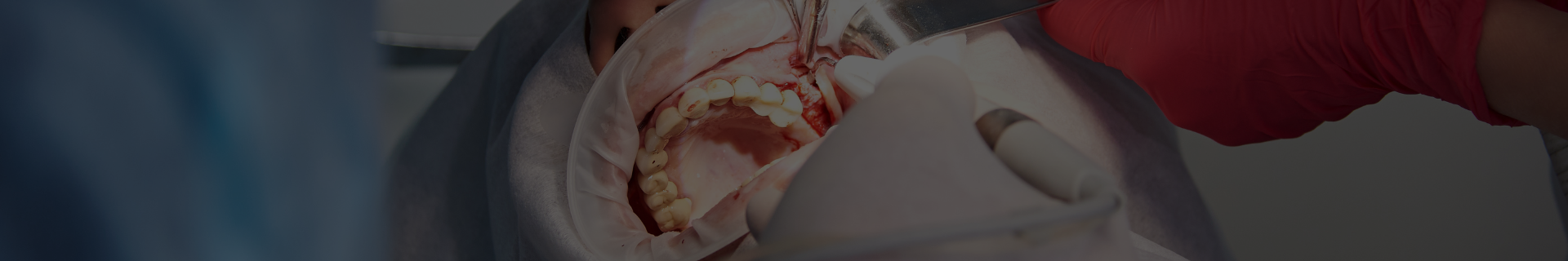 chirurgie dentara Bucuresti chirurgie orala Buzau