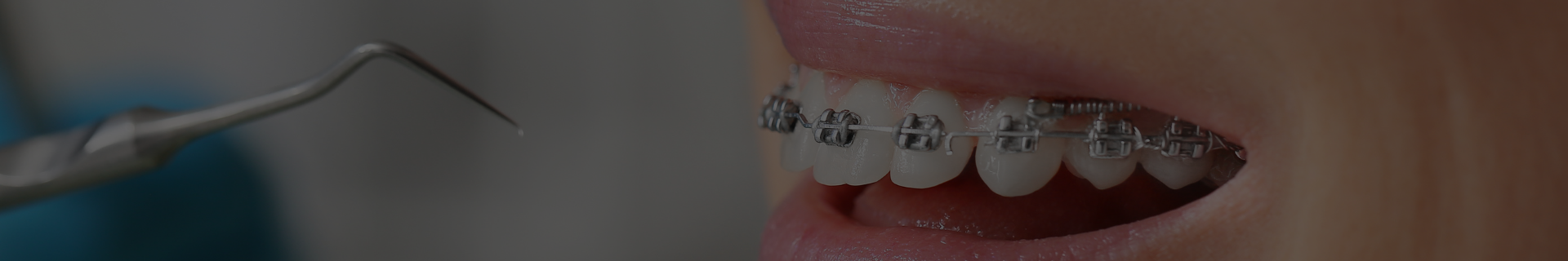 aparat dentar Bucuresti tratament ortodontic